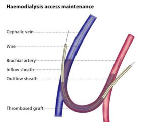 Hemodialysis catheter insertion – Dr. Manish Rajput